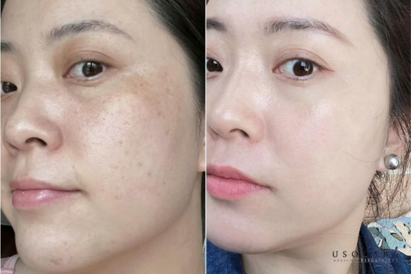 kem dưỡng ẩm sau peel