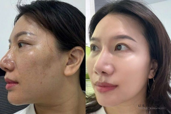 sau khi peel da nên đắp mặt nạ gì