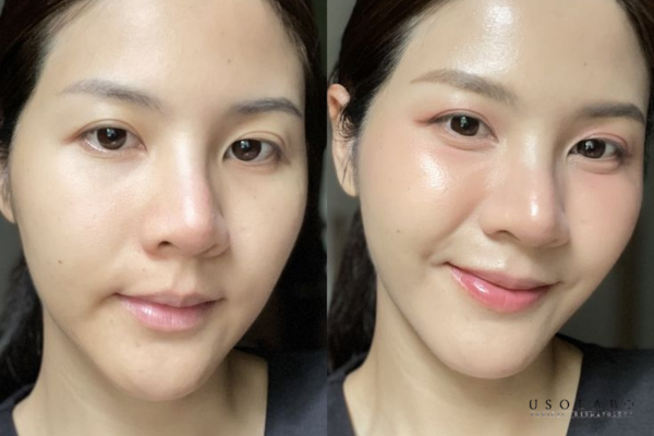 Người có làn da khô, da thiếu nước, da bong tróc