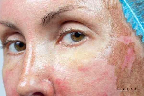 peel da có hại không