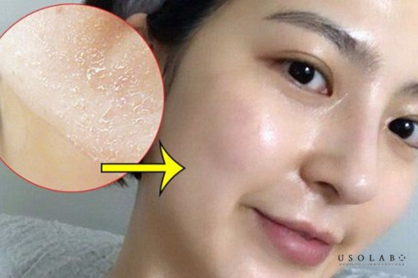 peel da sau bao lâu thì bong