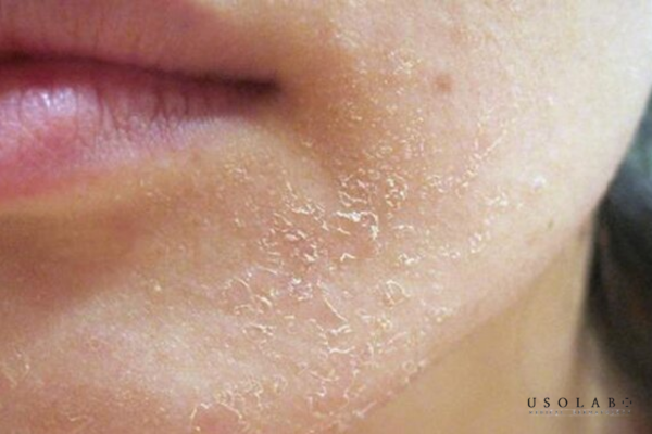 peel da sau bao lâu thì bong