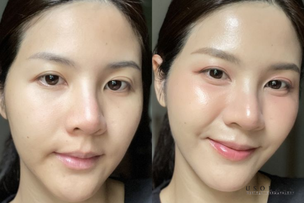 Peel da sinh học là phương pháp sử dụng enzyme tự nhiên Peel da sinh học là phương pháp sử dụng enzyme tự nhiên