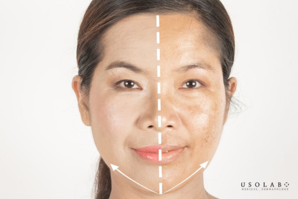 Peel da sinh học mang lại tác dụng cải thiện da theo hướng an toàn – bền vững Peel da sinh học mang lại tác dụng cải thiện da theo hướng an toàn – bền vững