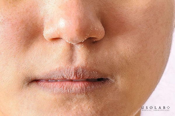 peel da xong nên làm gì