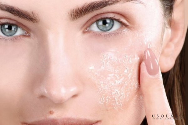 Peel da tại spa phù hợp với những người có làn da gặp các vấn đề dai dẳng Peel da tại spa phù hợp với những người có làn da gặp các vấn đề dai dẳng