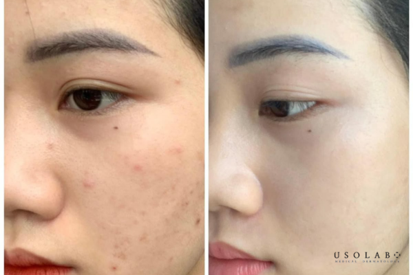 Vì sao tinh chất đường đen được quảng cáo trị mụn Vì sao tinh chất đường đen được quảng cáo trị mụn