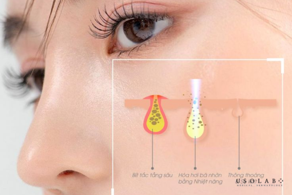 Hút dầu thừa, làm sạch bã nhờn