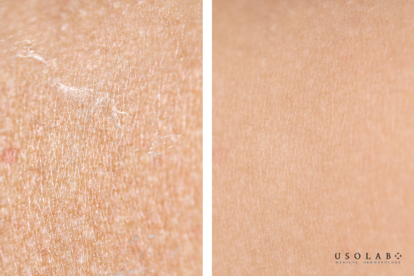 Da bị khô kéo dài do tổn thương hàng rào bảo vệ da (skin barrier). Da bị khô kéo dài do tổn thương hàng rào bảo vệ da (skin barrier).