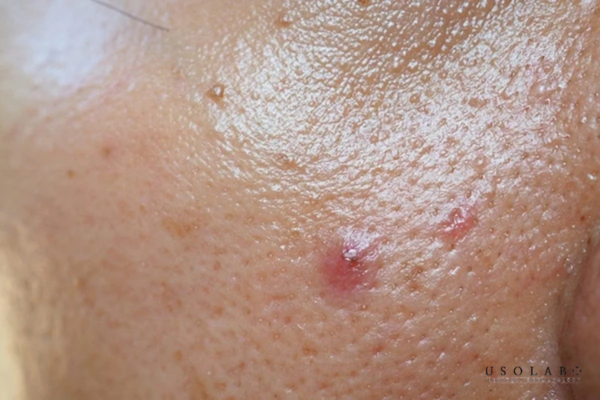 Da thường xuyên bóng nhờn