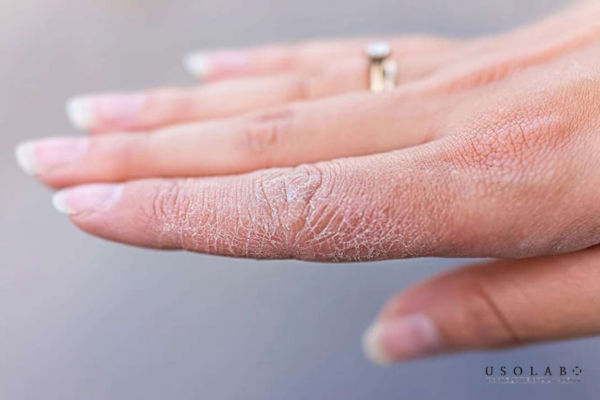 Da bong tróc và sần sùi