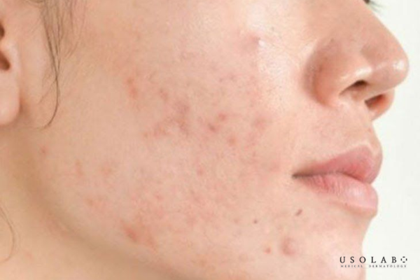 Chăm sóc da sau khi nặn mụn ở spa Chăm sóc da sau khi nặn mụn ở spa