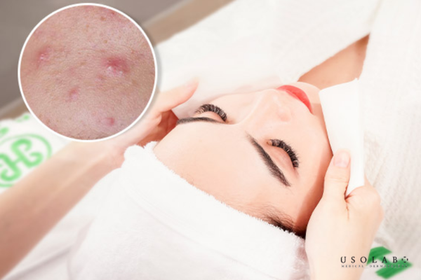 Quy trình chăm sóc da sau khi nặn mụn ở spa Quy trình chăm sóc da sau khi nặn mụn ở spa