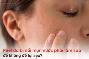 peel da bị nổi mụn nước