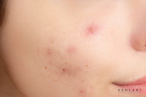 Thiếu vitamin và khoáng chất Thiếu vitamin và khoáng chất