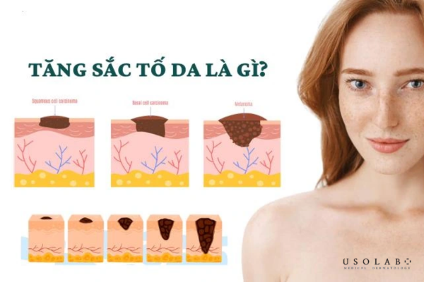 Tăng sắc tố melanin do ánh nắng Tăng sắc tố melanin do ánh nắng