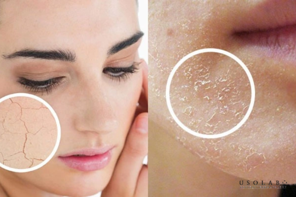 Rửa mặt quá nhiều hoặc dùng sữa rửa mặt có tính tẩy mạnh Rửa mặt quá nhiều hoặc dùng sữa rửa mặt có tính tẩy mạnh