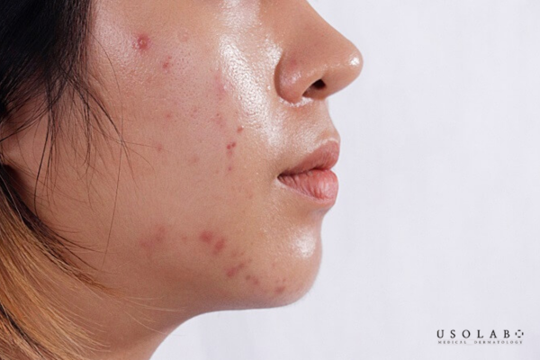 Những sai lầm khiến da khô dùng kem dưỡng vẫn bong tróc