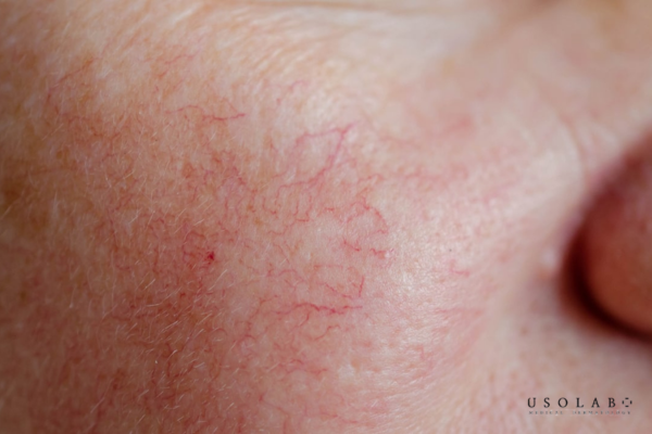 Gây giãn mao mạch dưới da Gây giãn mao mạch dưới da
