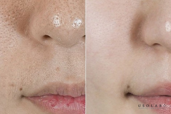 Làm sạch lỗ chân lông nhẹ nhàng Làm sạch lỗ chân lông nhẹ nhàng