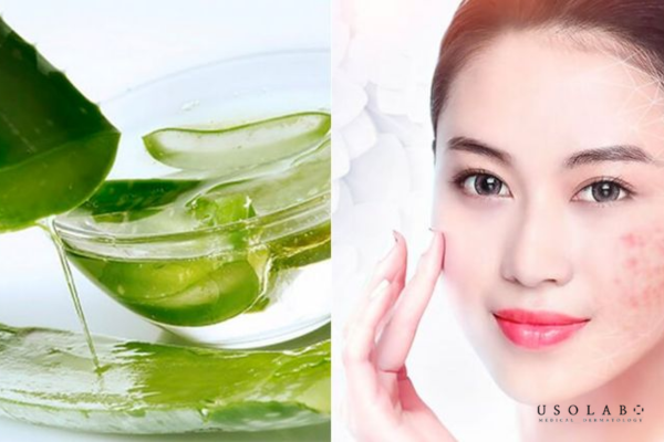 Mặt nạ nha đam giúp làm dịu da Mặt nạ nha đam giúp làm dịu da