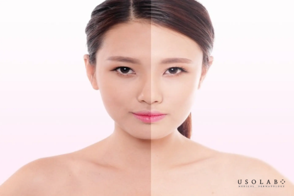 Trắng nhanh có phải là nâng tone hay thay đổi sắc tố