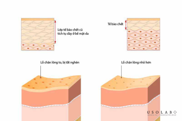 Loại bỏ tế bào chết, cải thiện độ sáng bề mặt