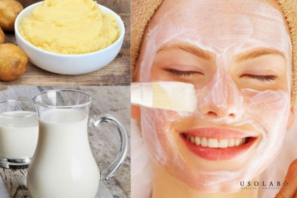Mặt nạ khoai tây + sữa