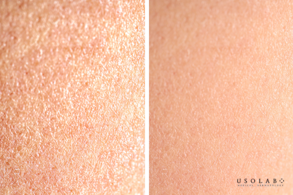 Da khô – chọn sản phẩm giàu dưỡng ẩm Da khô – chọn sản phẩm giàu dưỡng ẩm