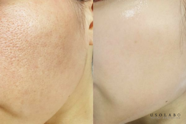 mặt nạ ủ trắng usolab