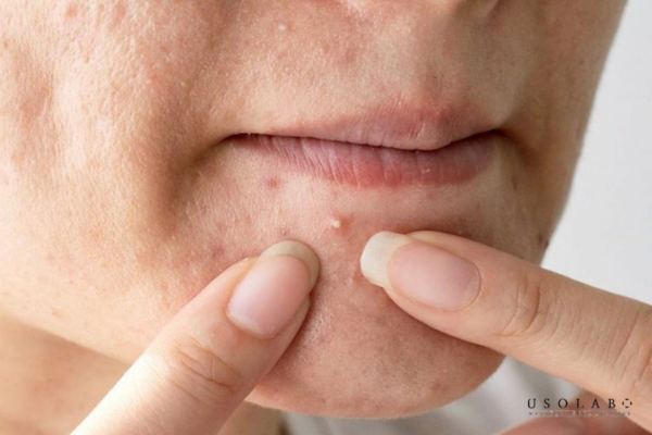 peel da bị nổi mụn nước