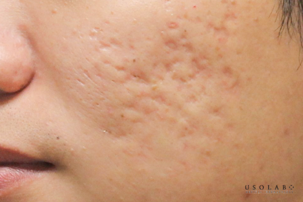 peel da bị nổi mụn nước