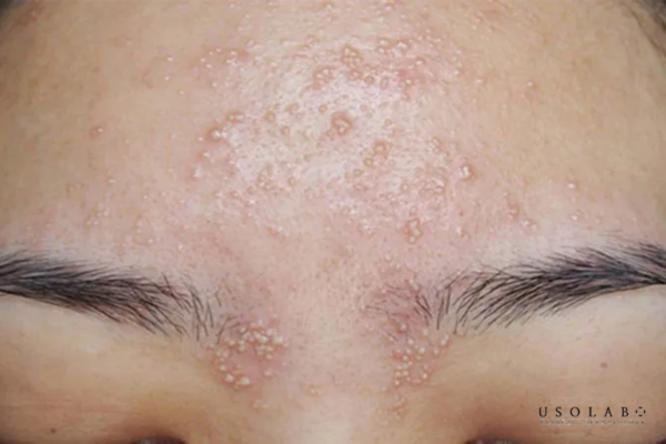 peel da bị nổi mụn nước