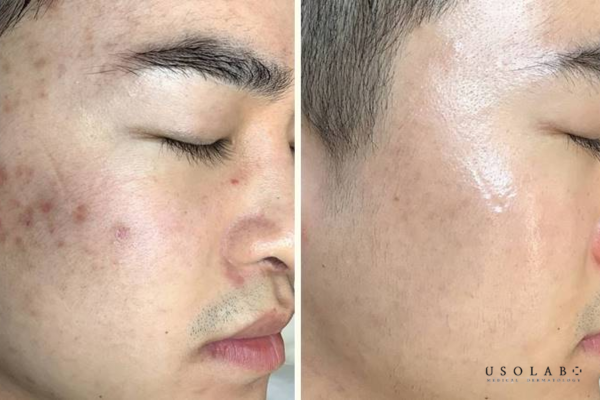 Khi peel được thực hiện đúng chỉ định, đúng nồng độ và đúng tần suất, da không bị mỏng đi