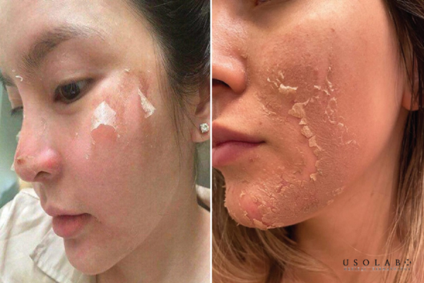 Là phương pháp sử dụng các hoạt chất acid sinh học như AHA, BHA, PHA hoặc TCA