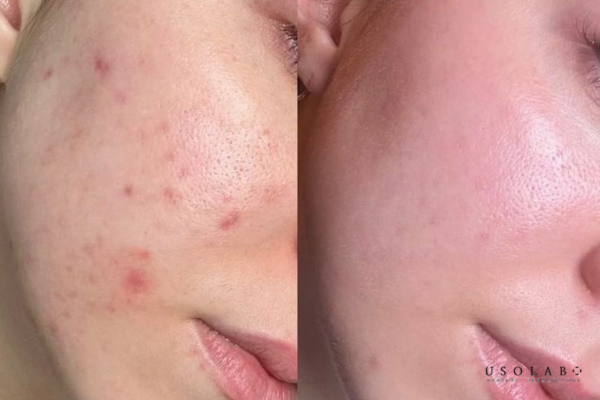 Lộ trình dùng retinol cho da khô từ beginner - advanced