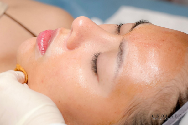 Lớp sừng bảo vệ (stratum corneum) bị loại bỏ có kiểm soát nhằm kích thích tái tạo biểu bì 