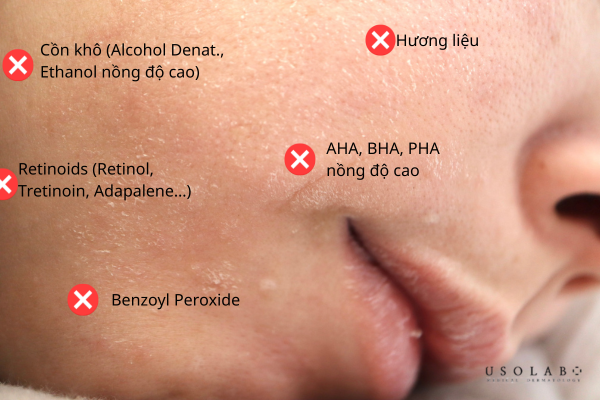 Serum phục hồi da sau peel KHÔNG nên chứa thành phần gì