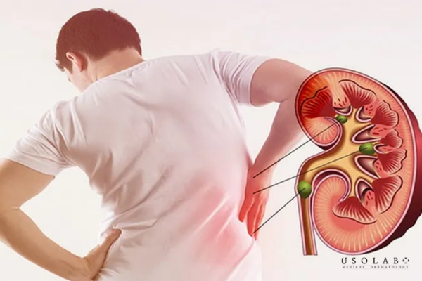 Nguy cơ sỏi thận