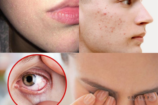 Thiếu Vitamin B1 (Thiamine) tác động trực tiếp đến sức khỏe làn da. Thiếu Vitamin B1 (Thiamine) tác động trực tiếp đến sức khỏe làn da.