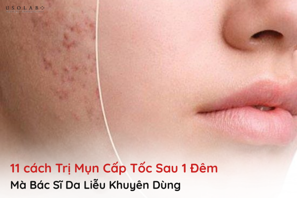 trị mụn cấp tốc sau 1 đêm