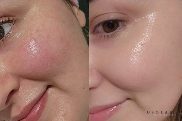 dầu dừa mang lại nhiều lợi ích như dưỡng ẩm, làm dịu và hỗ trợ phục hồi bảo vệ da