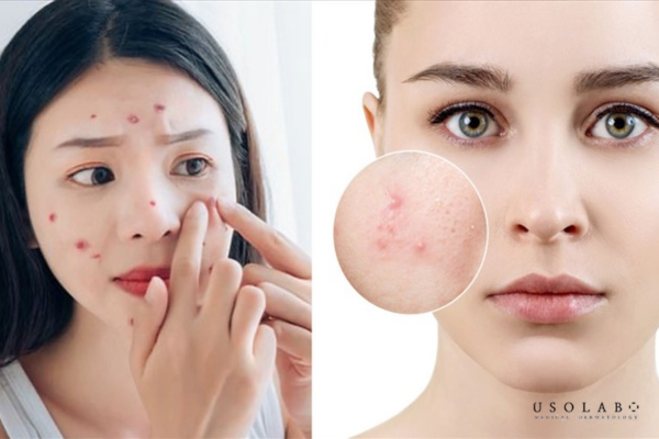 Dầu mè có thể gây mụn, nhưng không phải với tất cả mọi người