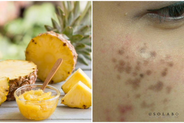 Không phải ai cũng phù hợp để sử dụng dứa trong chăm sóc da