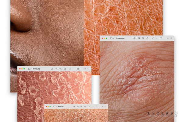 Da khô, bong tróc kéo dài Da khô, bong tróc kéo dài