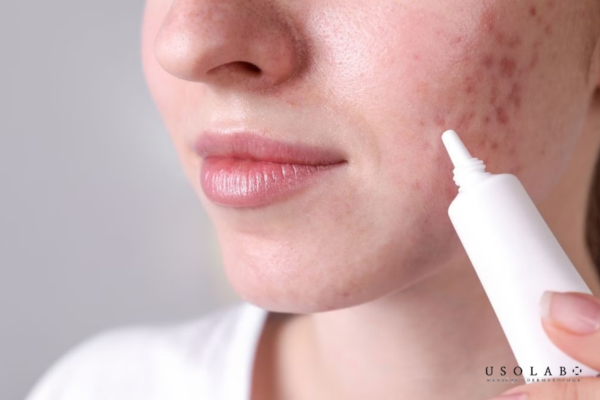 Lựa chọn kem trị mụn cần đặc biệt lưu ý những điều gì?