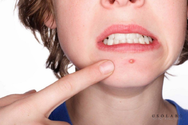 Nổi mụn ở cằm là thiếu chất gì? – Nguyên nhân và cách cải thiện từ bên trong