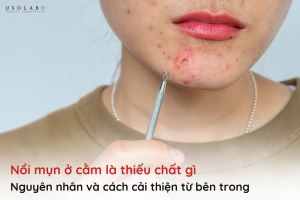 nổi mụn ở cằm là thiếu chất gì