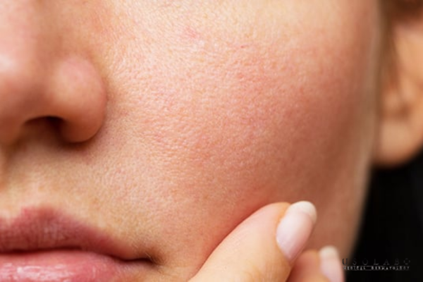 Da khô, thiếu ẩm, Da xỉn màu, không đều màu Da khô, thiếu ẩm, Da xỉn màu, không đều màu