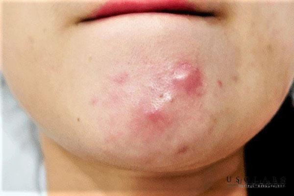 Mụn Sưng đỏ và đau nhức nguyên nhân do đâu?